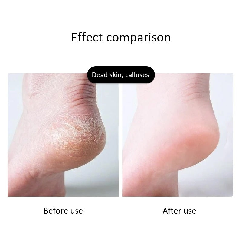 Professional Double-Sided Foot Scraper & Callus Remover